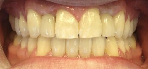 After implants and aligners