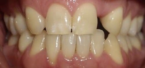 Before whitening and contouring