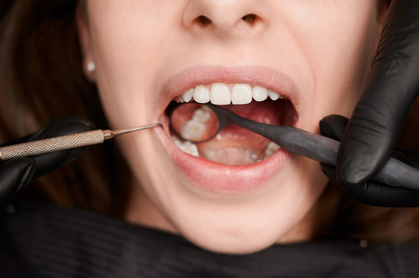 fillings